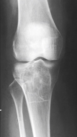 Giant Cell Tumor Of Bone | Radiology Reference Article | Radiopaedia.org