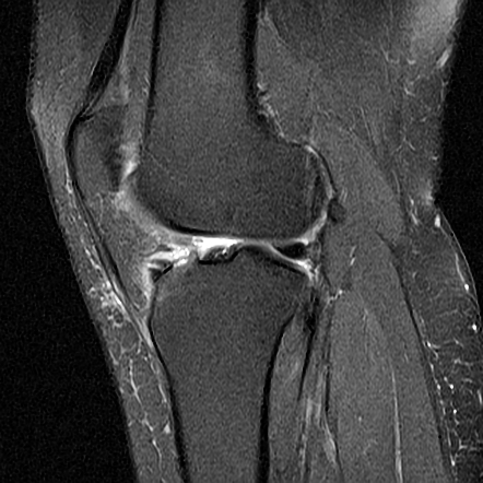 Anterior Root Attachment Tear - Medial Meniscus 