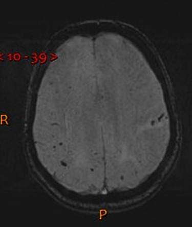 Cerebral microhemorrhage | Radiology Reference Article | Radiopaedia.org