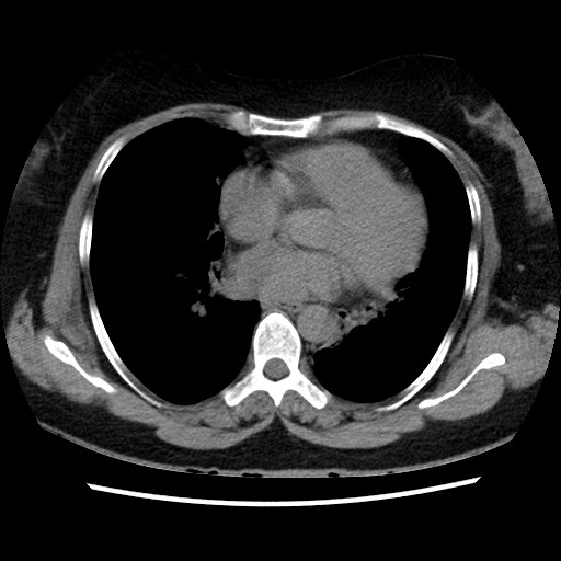 Cystic Bronchiectasis | Image | Radiopaedia.org