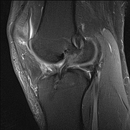 ACL reconstruction graft fraying | Radiology Case | Radiopaedia.org