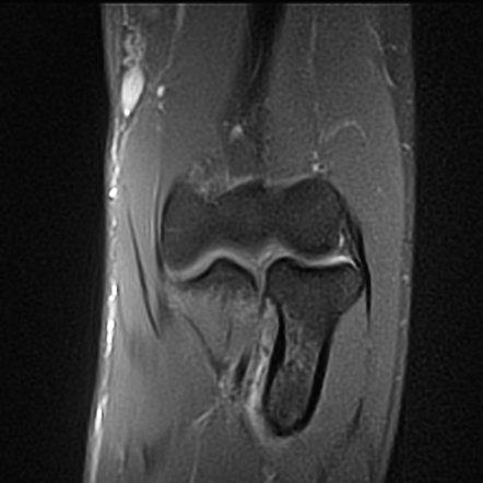 Distal biceps brachii tendon rupture | Image | Radiopaedia.org