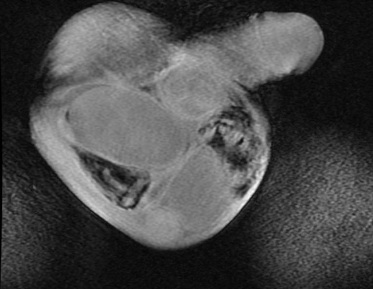 Scrotal Adenomatoid Tumor Image