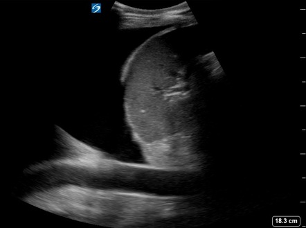 Pleural Effusion On Point Of Care Ultrasound Pocus Radiology Case Radiopaedia Org