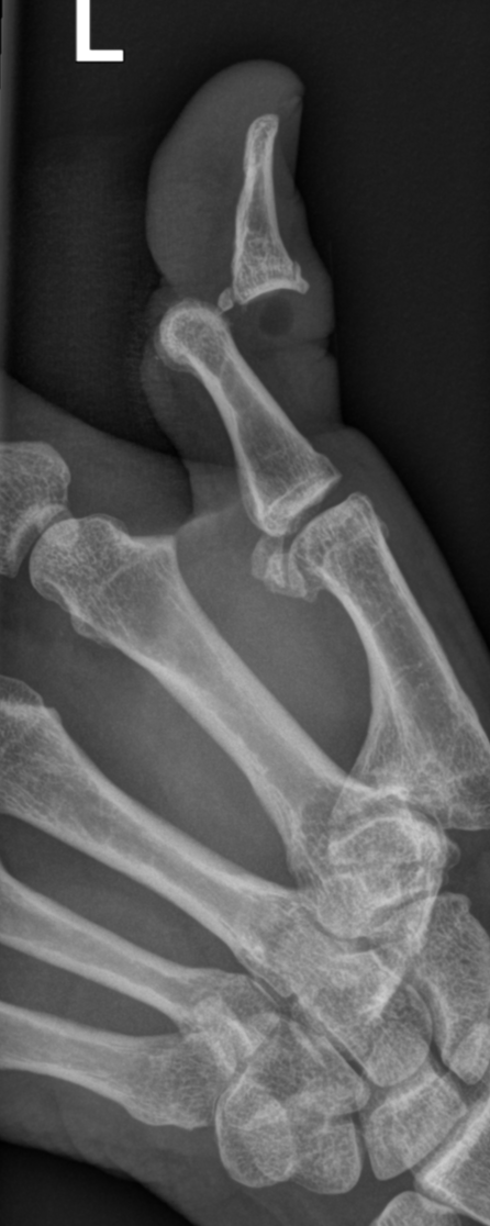 Interphalangeal joint dislocation - thumb | Image | Radiopaedia.org