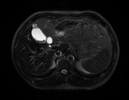 Gallbladder adenomyomatosis | Image | Radiopaedia.org