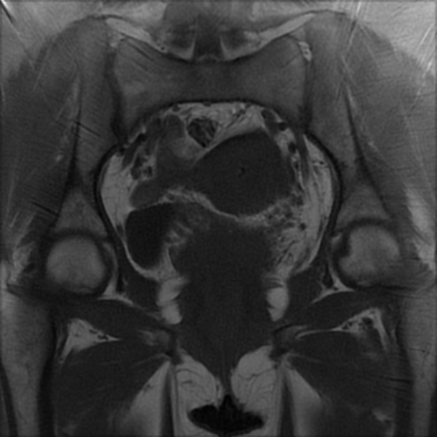 Inflamed urethral diverticula | Image | Radiopaedia.org