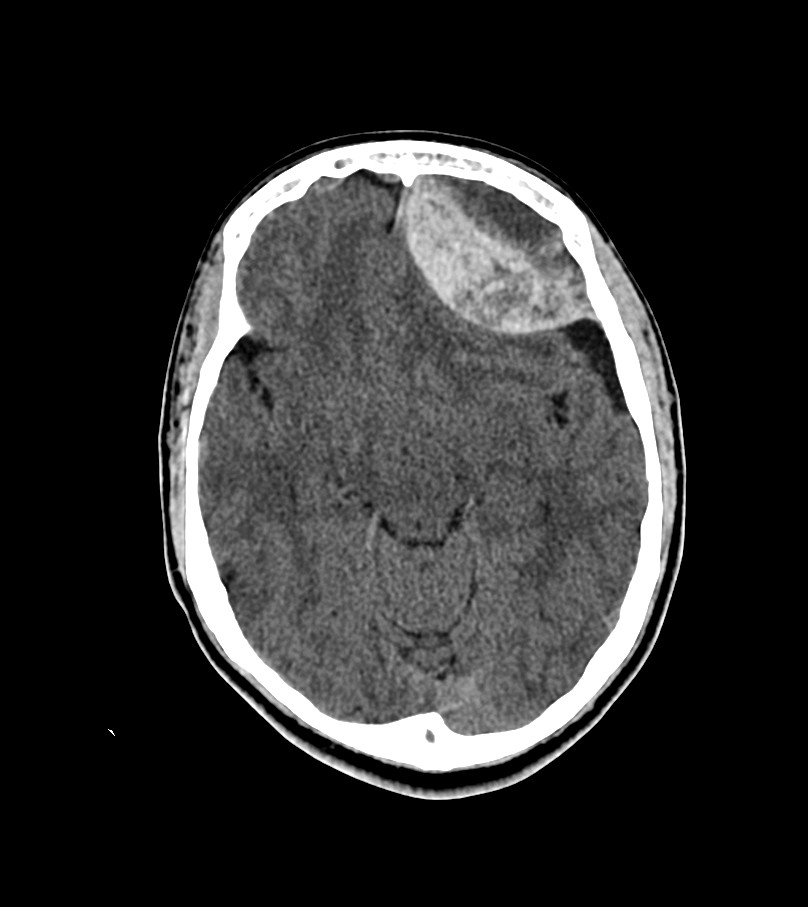 Bilateral retrobulbar hemorrhage | Image | Radiopaedia.org