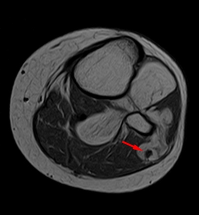 Common Peroneal Nerve Radiology Reference Article Radiopaedia Org