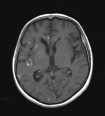 Enhancing brain lesions after endovascular aneurysm treatment | Image ...