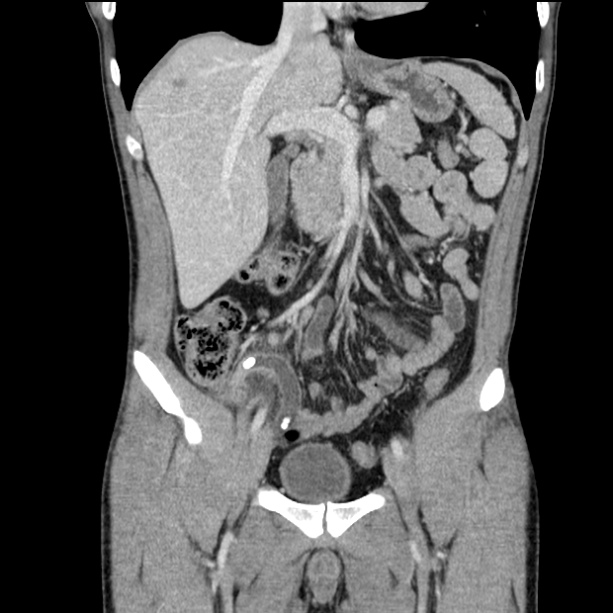 Acute appendicitis | Image | Radiopaedia.org