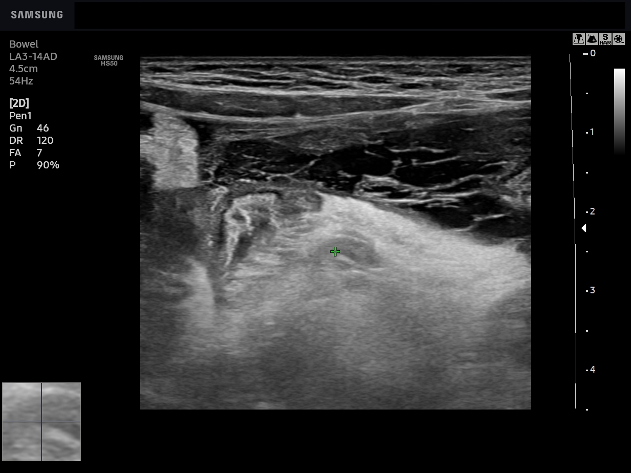 Appendicitis With Appendicular Abscess Image