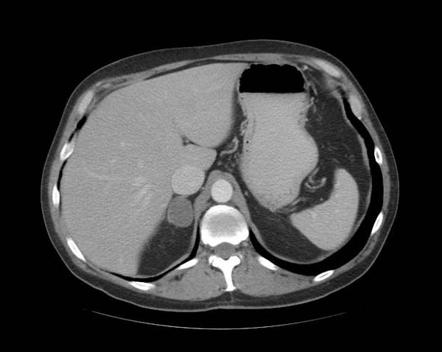 Adrenal adenoma | Radiology Case | Radiopaedia.org