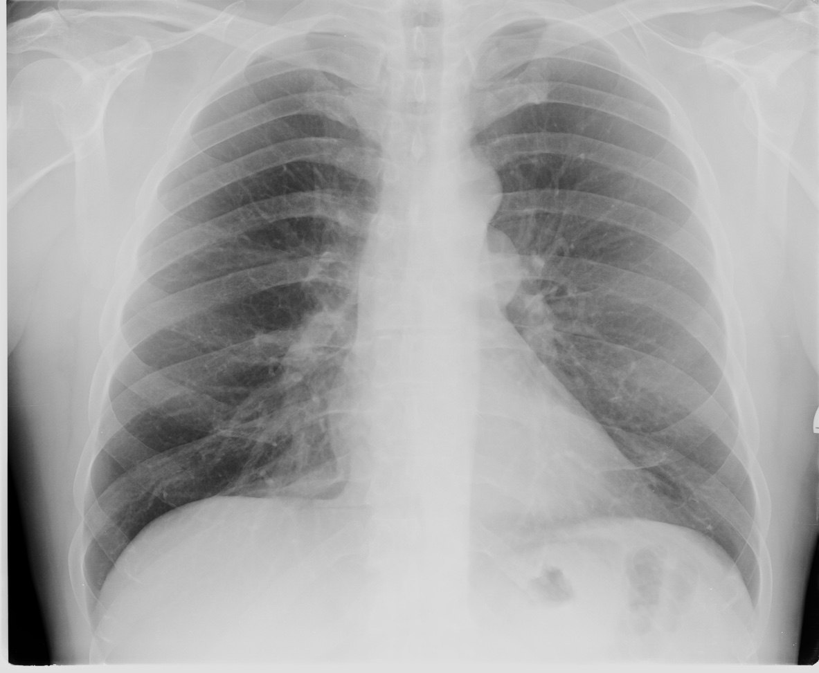 Malignant thymoma | Image | Radiopaedia.org