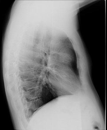 Malignant thymoma | Image | Radiopaedia.org