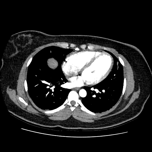 Celiac trunk compression syndrome and aberrant left hepatic artery ...