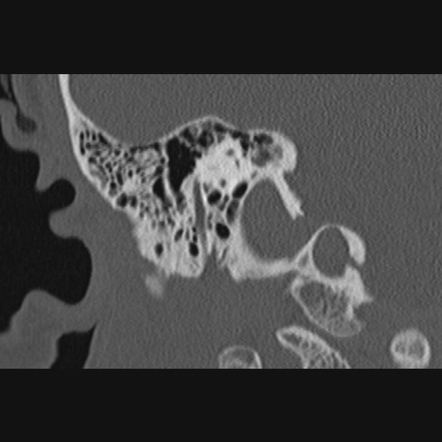 Fenestral otosclerosis - bilateral | Image | Radiopaedia.org