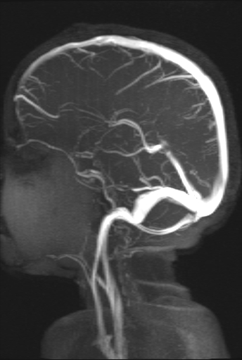 Occipital sinus with normal caliber transverse sinuses | Image ...