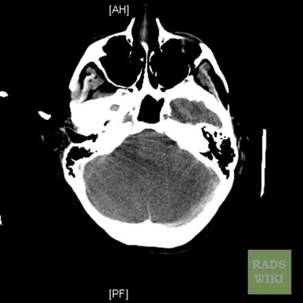 Anoxic Brain Injury | Radiology Case | Radiopaedia.org