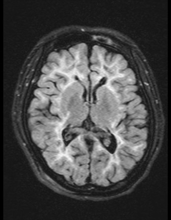 Cerebral autosomal dominant arteriopathy with subcortical infarcts and ...