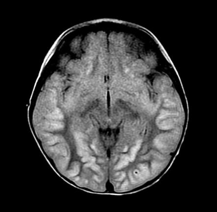 Anoxic Brain Injury | Radiology Case | Radiopaedia.org