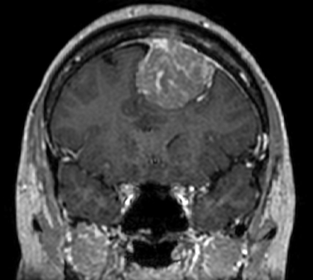 Atypical meningioma - grade II | Radiology Case | Radiopaedia.org