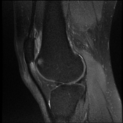 Patellofemoral instability | Radiology Reference Article | Radiopaedia.org