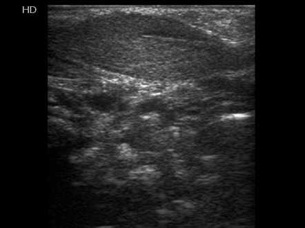 Fibromatosis colli | Image | Radiopaedia.org