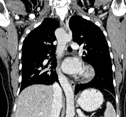 Right-sided Aortic Arch With Aberrant Left Subclavian Artery And 