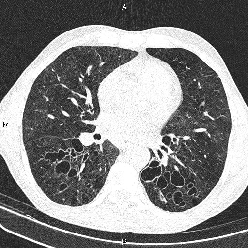 Cystic bronchiectasis - brunch of grapes appearance | Image ...