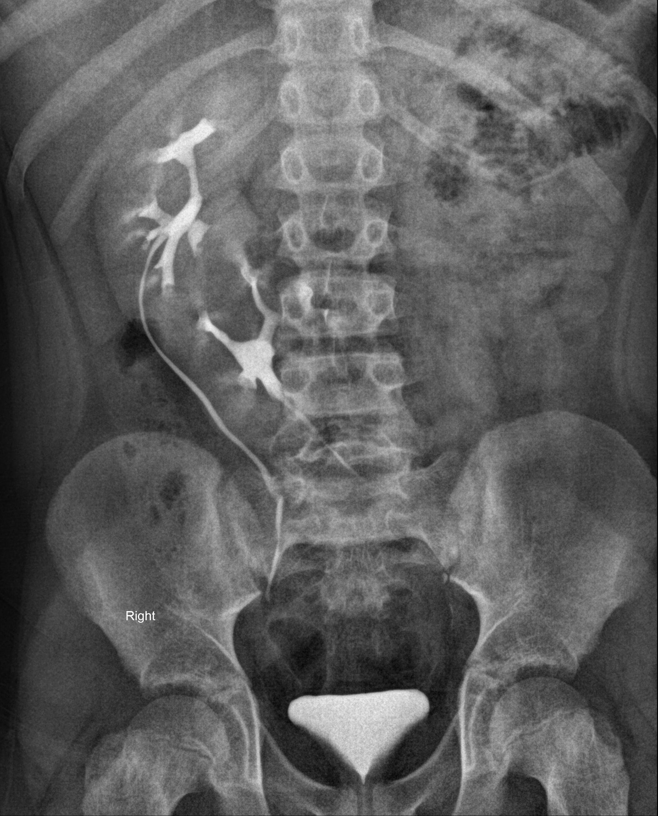 Crossed fused renal ectopia Image