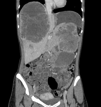 Metastasising pleomorphic adenoma | Radiology Case | Radiopaedia.org