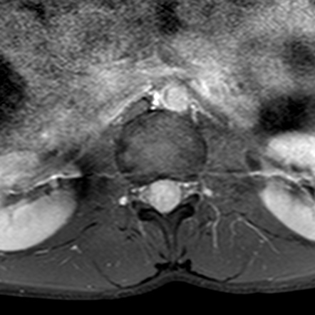 Spinal ependymoma | Image | Radiopaedia.org