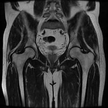 Piriformis Syndrome Radiology Case Radiopaedia Org