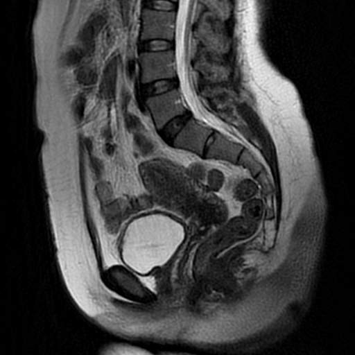 Endometriomas T2 Shading Sign Image 