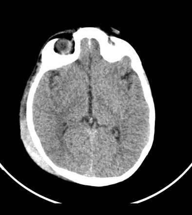 Subgaleal hematoma with retrobulbar extension | Image | Radiopaedia.org