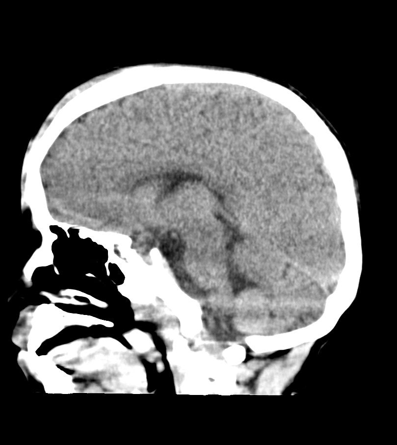 Subgaleal Hematoma With Retrobulbar Extension Image