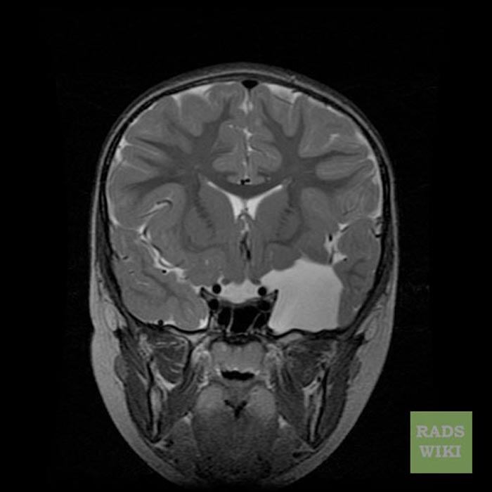 Arachnoid cyst | Image | Radiopaedia.org