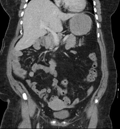 Intestinal malrotation | Radiology Case | Radiopaedia.org