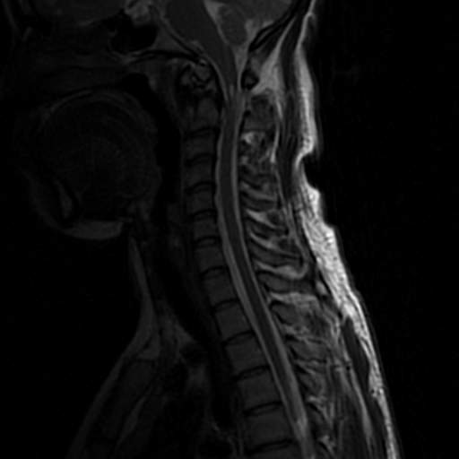 Dystopic os odontoideum with atlantoaxial subluxation | Image ...