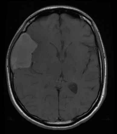 Arachnoid cyst | Radiology Reference Article | Radiopaedia.org