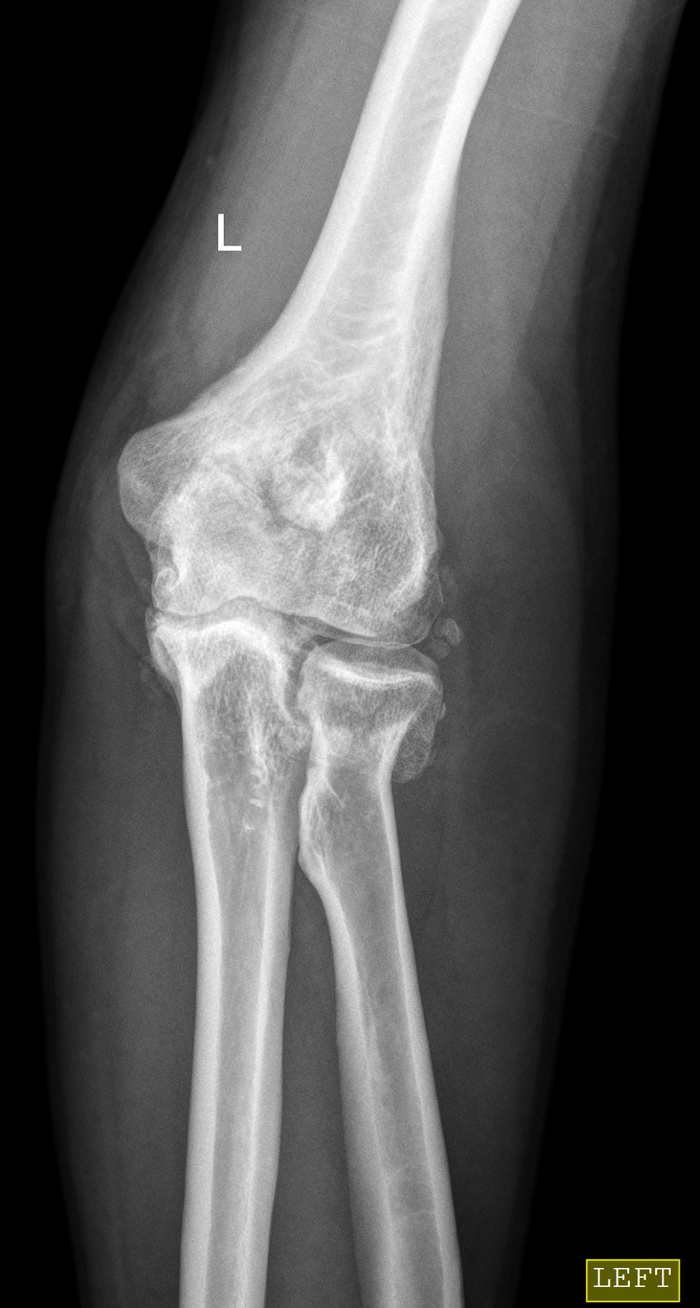 Normal Pediatric Elbow X Ray