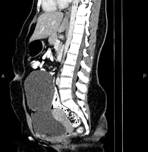 Paraovarian cyst | Image | Radiopaedia.org