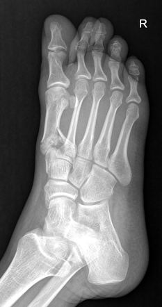 1st metatarsal base comminuted fracture | Image | Radiopaedia.org