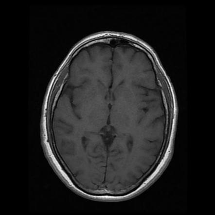 Anterior Inferior Cerebellar Artery Vascular Loop - Type III | Image ...