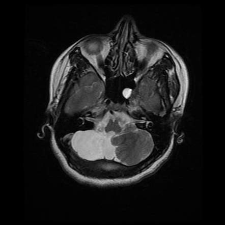 Unilateral cerebellar agenesis | Radiology Case | Radiopaedia.org