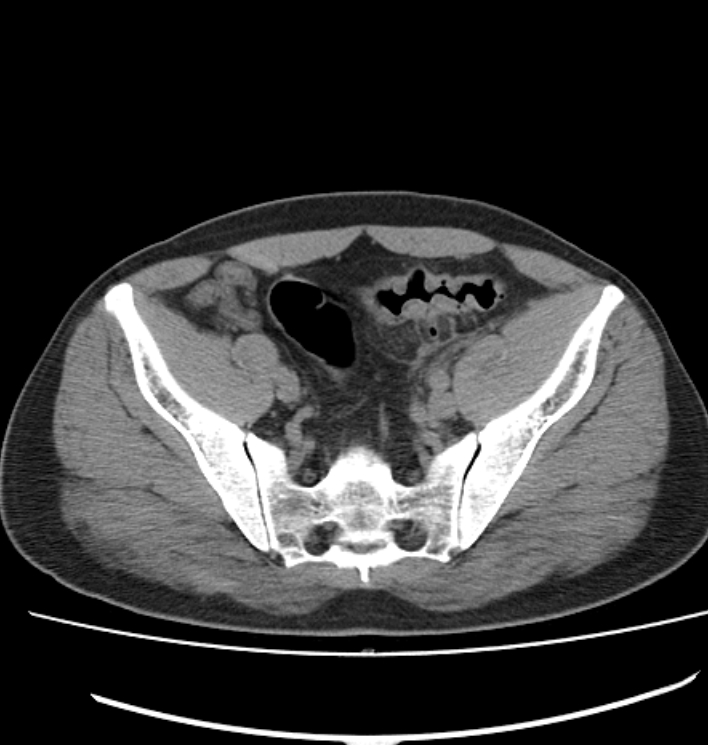 Perforated sigmoid diverticulitis with abscess formation | Image ...