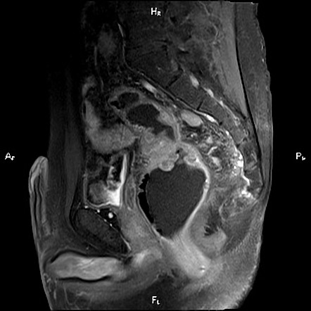 Rectal adenocarcinoma | Image | Radiopaedia.org