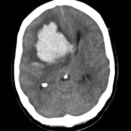 Lobar hemorrhage due to cerebral amyloid angiopathy | Image ...