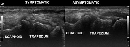 Acute calcific periarthritis - wrist | Radiology Case | Radiopaedia.org